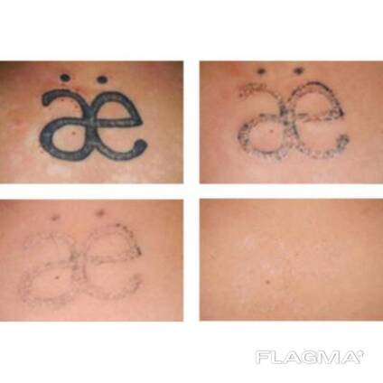 Tatoo remover Cream in Pietermaritzburg