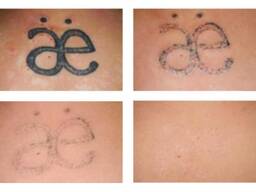 Tatoo remover Cream in Pietermaritzburg