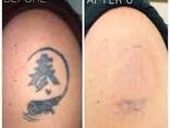 Tatoo remover Cream in Pietermaritzburg - photo 2